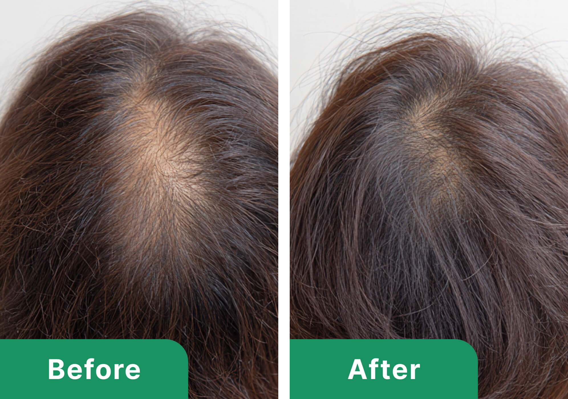 60代女性のビフォーアフター写真（施術6ヶ月）