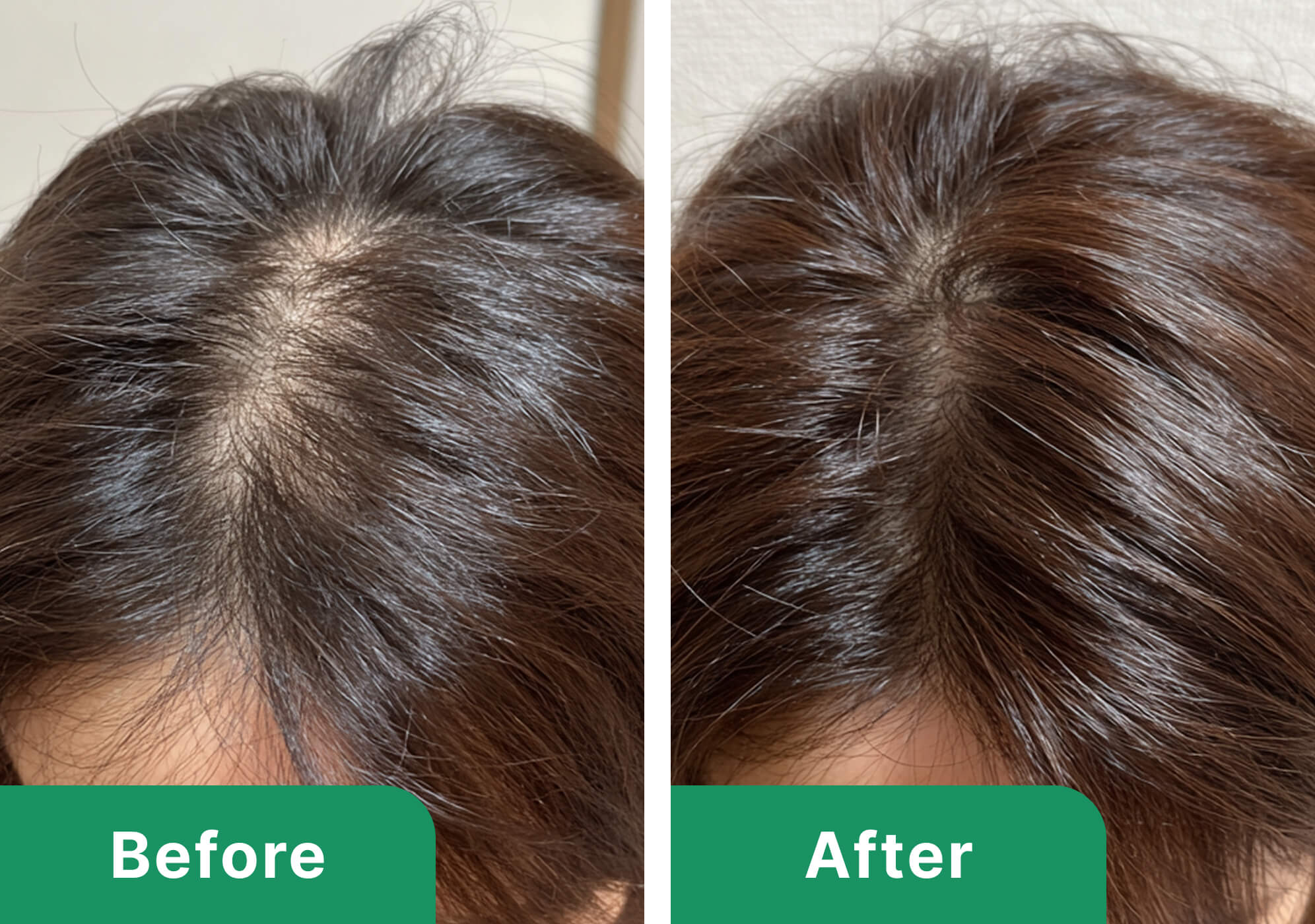 40代女性のビフォーアフター写真（施術3ヶ月）