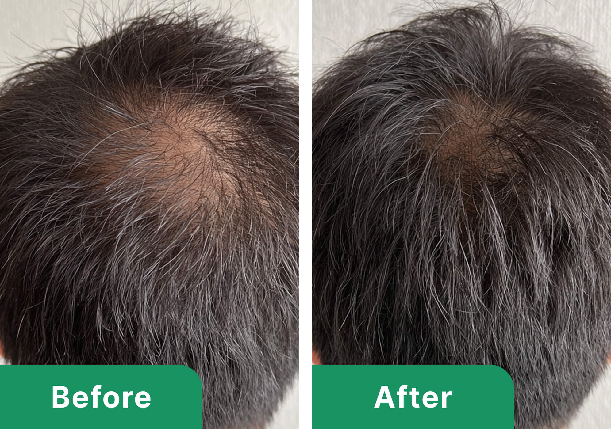 50代男性のビフォーアフター写真（施術6ヶ月）