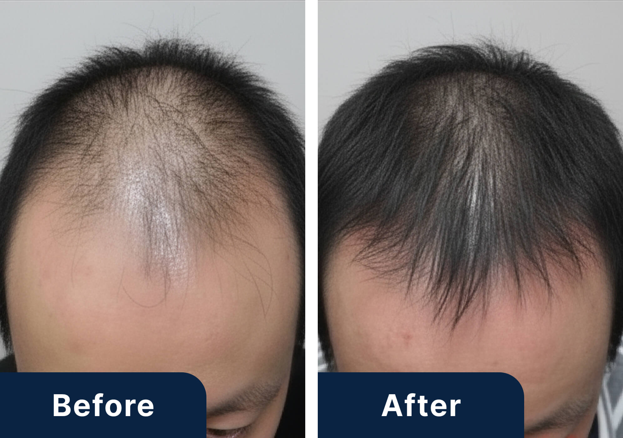 40代男性のビフォーアフター写真（施術6ヶ月）