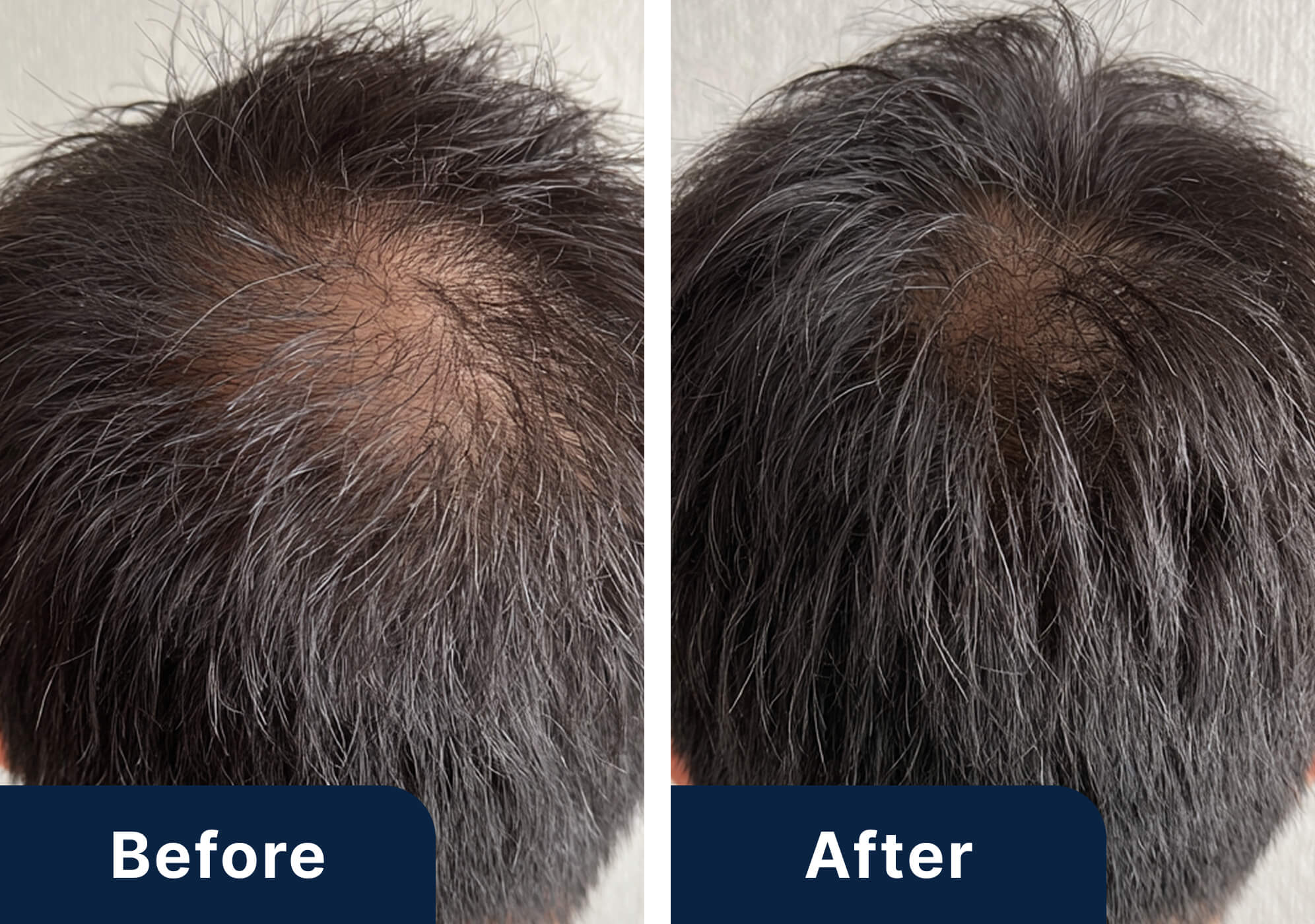 50代男性のビフォーアフター写真（施術6ヶ月）