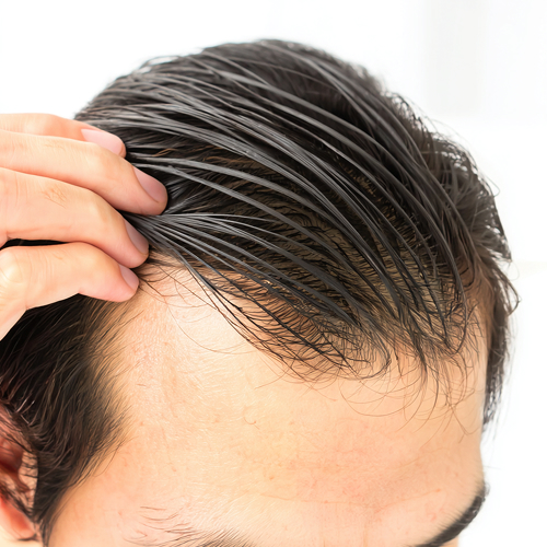 薄毛で生え際が気になる