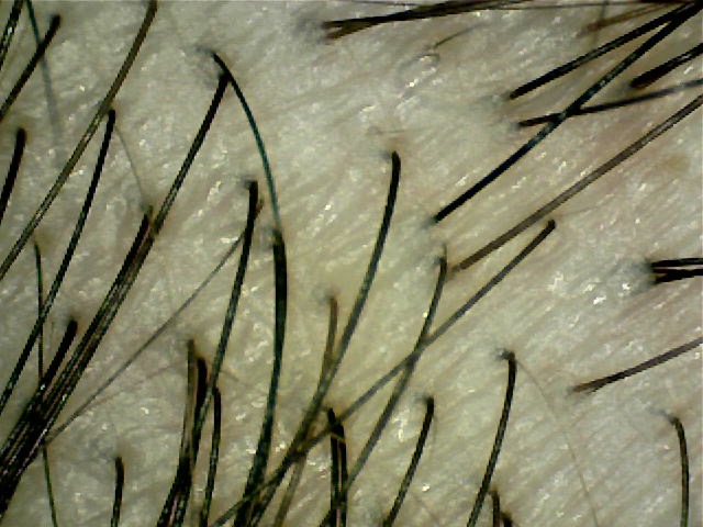 マイクロスコープで見た健康な頭皮