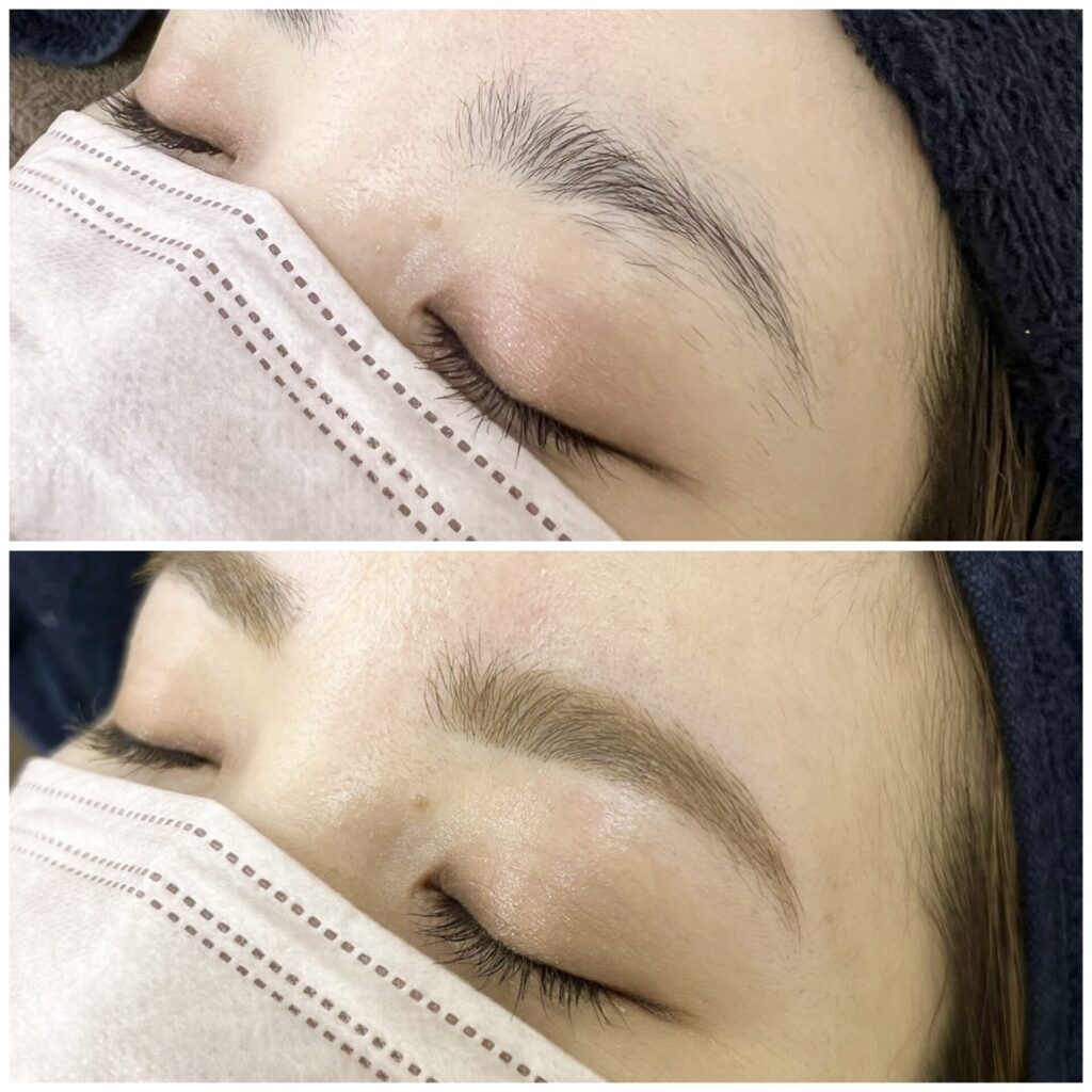 眉毛脱毛のビフォーアフター